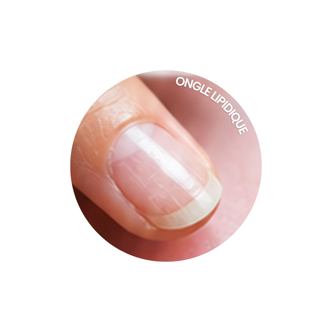 Plaque ongle lipidique Zoom sur un ongle lipidique, gras et/ou humide